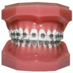 Standard Metal Braces